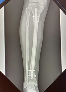 Fractura tibia y perone