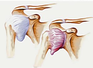 Capsulitis retráctil