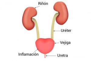 Infección de orina